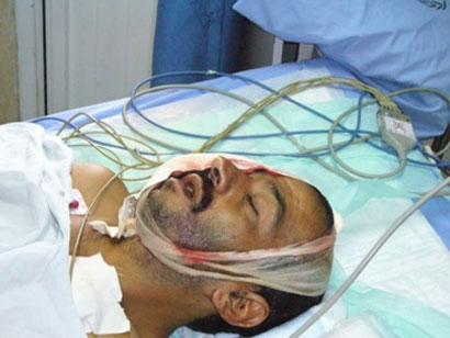 Un habitant de Nilin dans un état critique après avoir reçu plusieurs balles de caoutchouc dans la tête