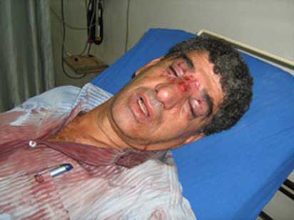 Un membre du Comité Populaire de Ni’lin blessé au visage par une bombe lacrymogène