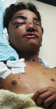 Rendu aveugle et grièvement brûlé : Mahmoud (quatorze ans), victime d’un bombardement israélien au phosphore blanc (arme prohibée)