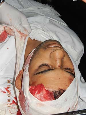 Un martyr et 5 blessés cet après-midi dans la Bande de Gaza assiégée sous les tirs des terroristes sionistes