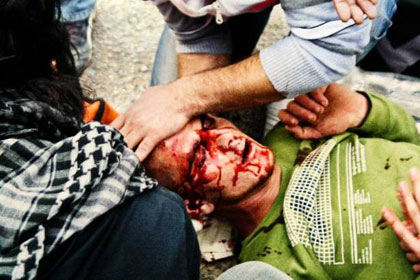 Un jeune Palestinien blessé à la tête par une grenade lacrymogène à An Nabi Saleh